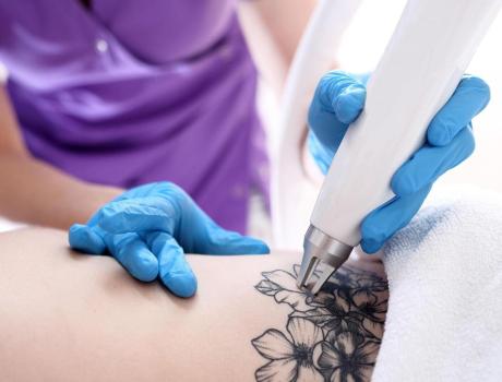 Dövme Silme (Tattoo Removal) - Dövme Silme (Tattoo Removal)